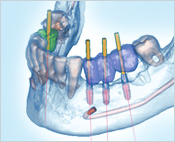 Foto Implantat